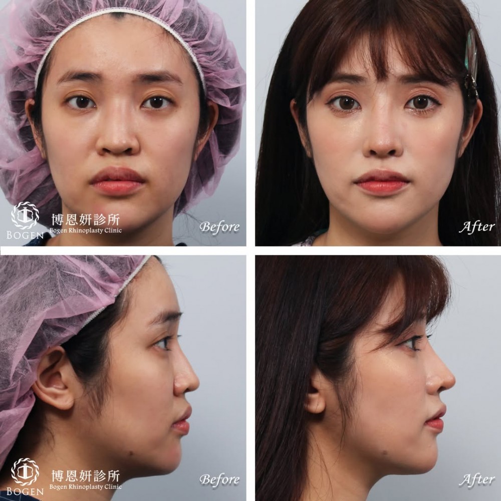 玻尿酸隆鼻植入劑殘留物清除,鼻重修,博恩妍